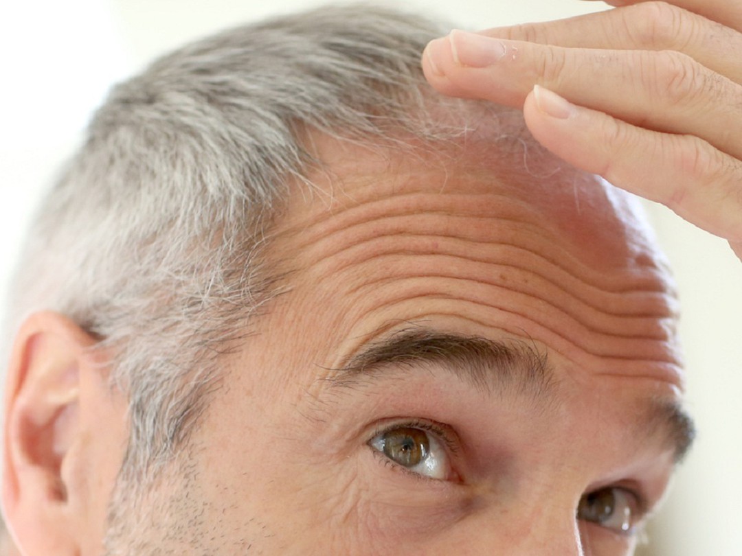 Làm thế nào để ngăn ngừa rụng tóc ở người lớn tuổi