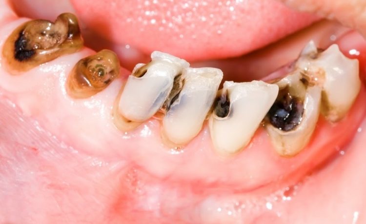 Hình ảnh hàm răng bị sâu