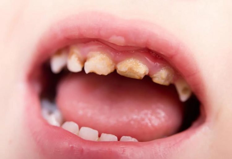 Bệnh viêm răng lợi ở trẻ nhỏ